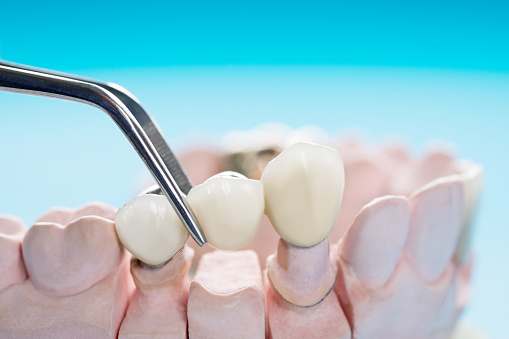Dental bridges — original treatment illustration