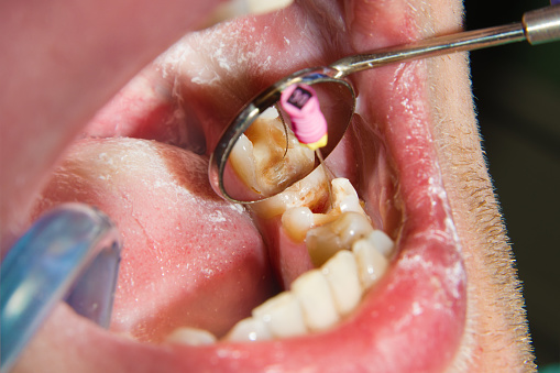 What endodontics does for your teeth — original treatment illustration