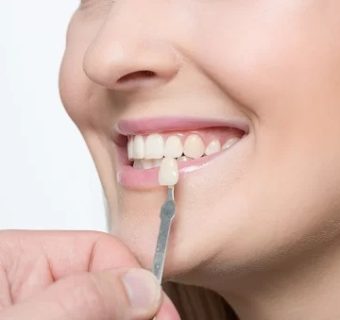 Dental veneers — original treatment illustration