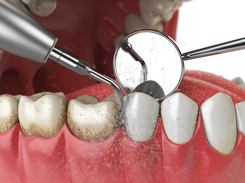Teeth polishing and surface stains — original treatment illustration