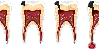 Root canal re-treatment — original treatment illustration