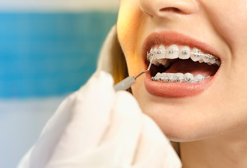 Dental braces — original treatment illustration