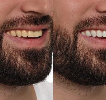 Teeth whitening — original treatment illustration