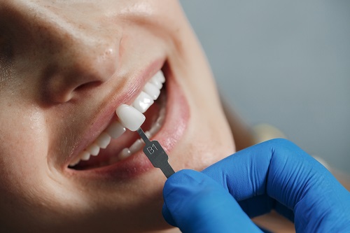 Dental bonding — original treatment illustration