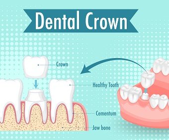 Dental crowns — original treatment illustration