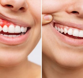 Gum reshaping — original treatment illustration