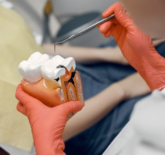 Single-visit root canal treatment — original treatment illustration