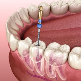 Root canal treatment — original treatment illustration