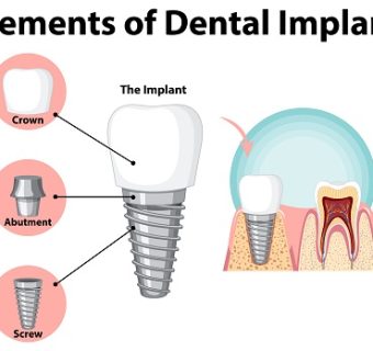 Dental implants & oral surgery — original treatment illustration