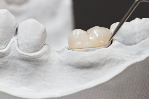 Dental inlays & onlays — original treatment illustration