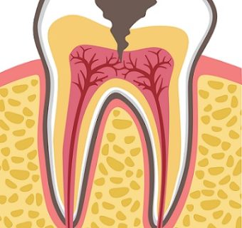 Single-visit root canal treatment — original treatment illustration