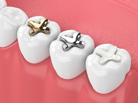 Dental fillings — original treatment illustration