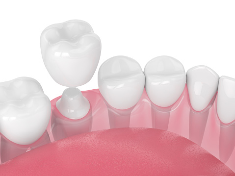 Dental inlays & onlays — original treatment illustration