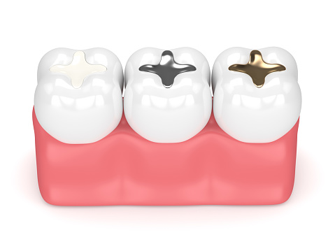 Dental fillings — original treatment illustration
